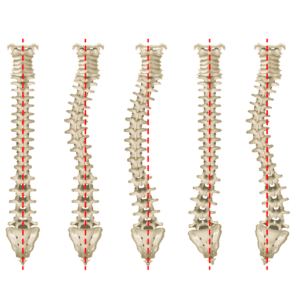 escoliosis