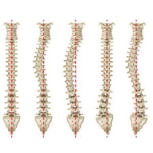 escoliosis