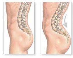 Hiperlordosis_lumbar