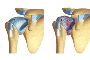 Hombro_congelado_o_capsulitis_adhesiva