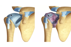 Hombro_congelado_o_capsulitis_adhesiva