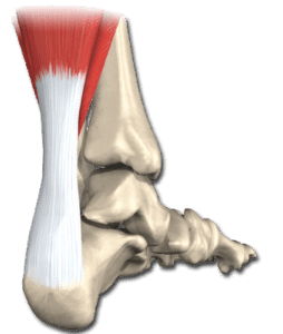 Tendinitis_aquílea