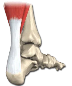 Tendinitis_aquílea