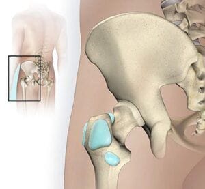 bursitis
