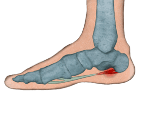 Fascitis_plantar. Espolón_calcáneo