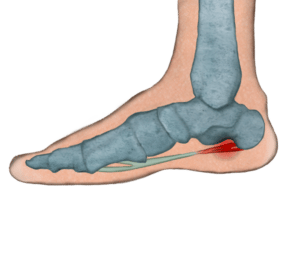 Fascitis_plantar. Espolón_calcáneo