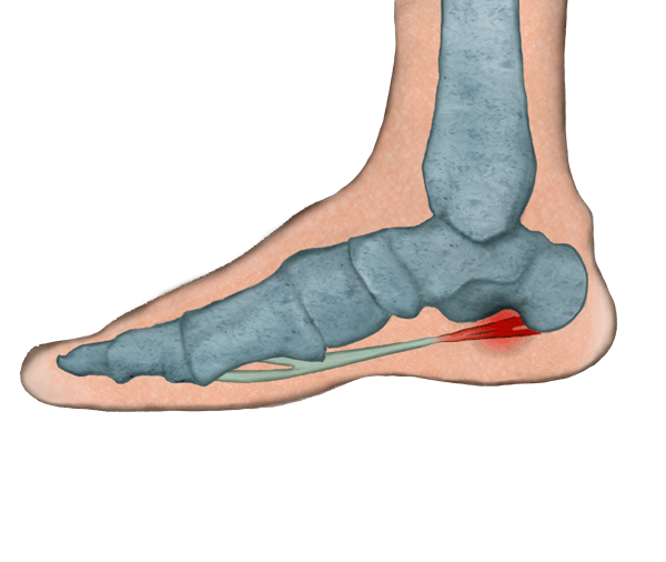 Fascitis_plantar. Espolón_calcáneo
