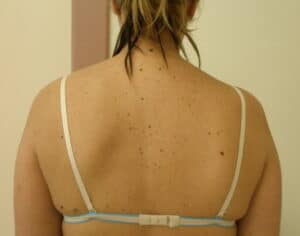 neuropatia_nervio_espinal_accesorio