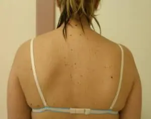neuropatia_nervio_espinal_accesorio