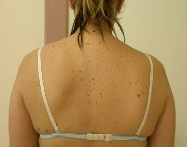 neuropatia_nervio_espinal_accesorio