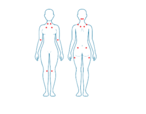 Fibromialgia-y-fisioterapia