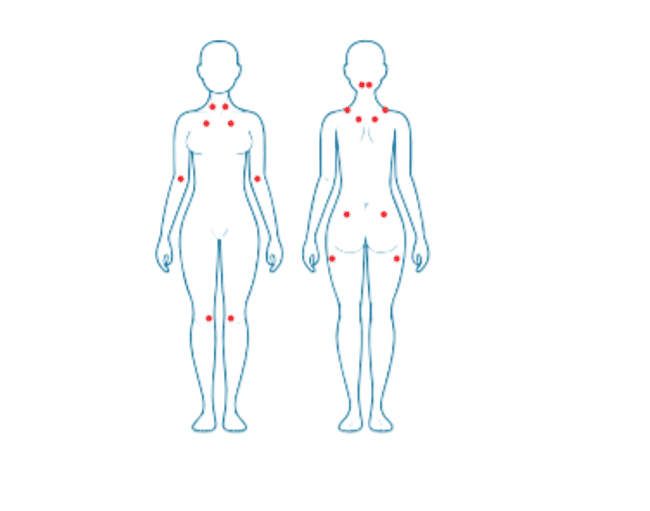 Fibromialgia-y-fisioterapia