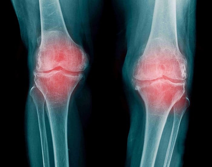 Artrosis-y-fisioterapia