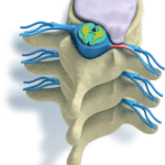 Hernia-discal