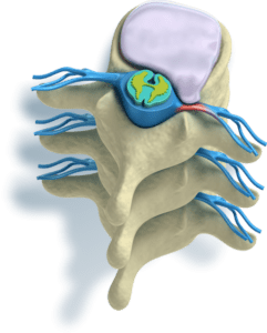 Hernia-discal