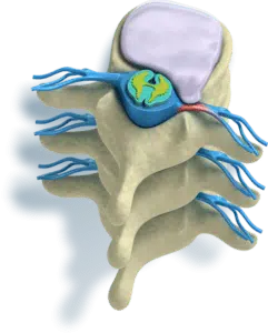 Hernia-discal