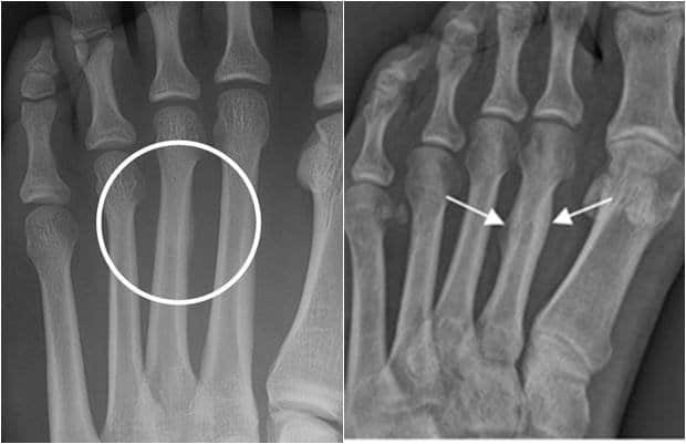 fractura-por-estres