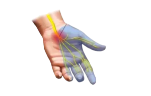 sindrome-tunel-carpiano
