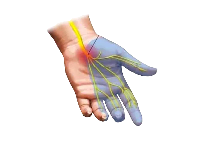 sindrome-tunel-carpiano