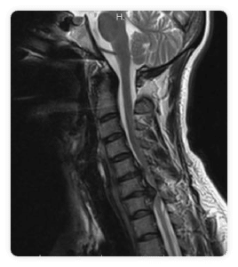 hernia-discal-cervical