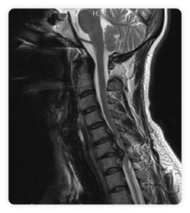 hernia-discal-cervical