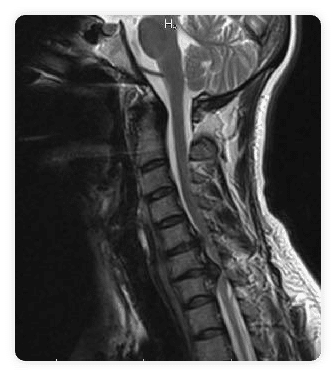 hernia-discal-cervical