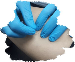 fisioterapeuta-aplicando-punción-seca