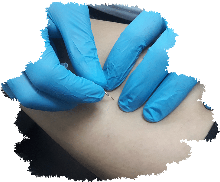 fisioterapeuta-aplicando-punción-seca