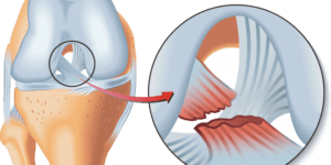 rotura-ligamento-cruzado-anterior