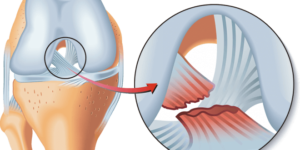 rotura-ligamento-cruzado-anterior