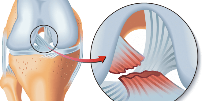 rotura-ligamento-cruzado-anterior